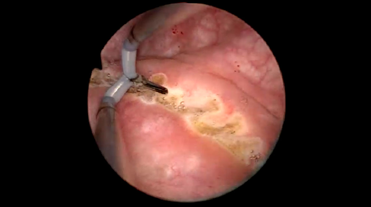 Laparoscopic Partial Bladder Cystectomy for Bladder Endometriosis