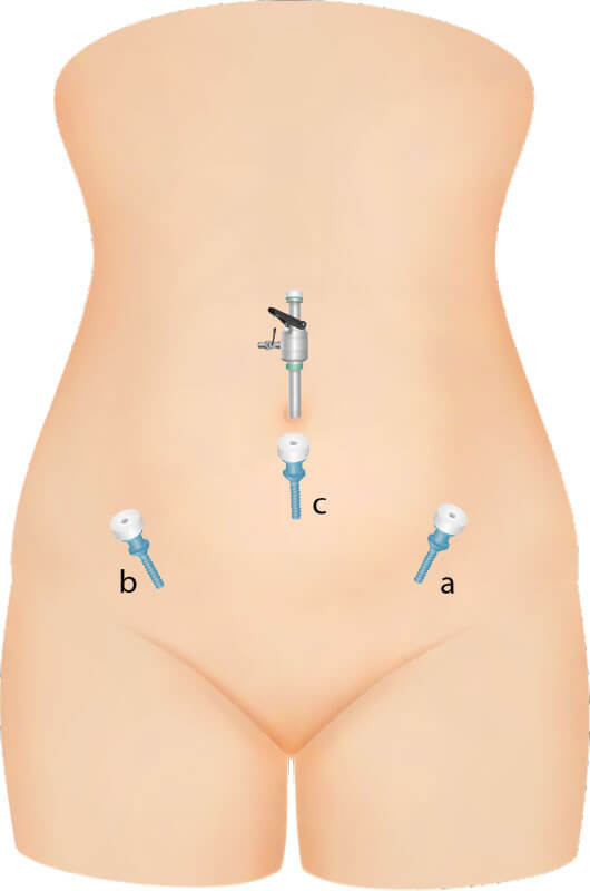 Tips and Tricks in Laparoscopic Surgery - Port Placement - Melaka Fertility