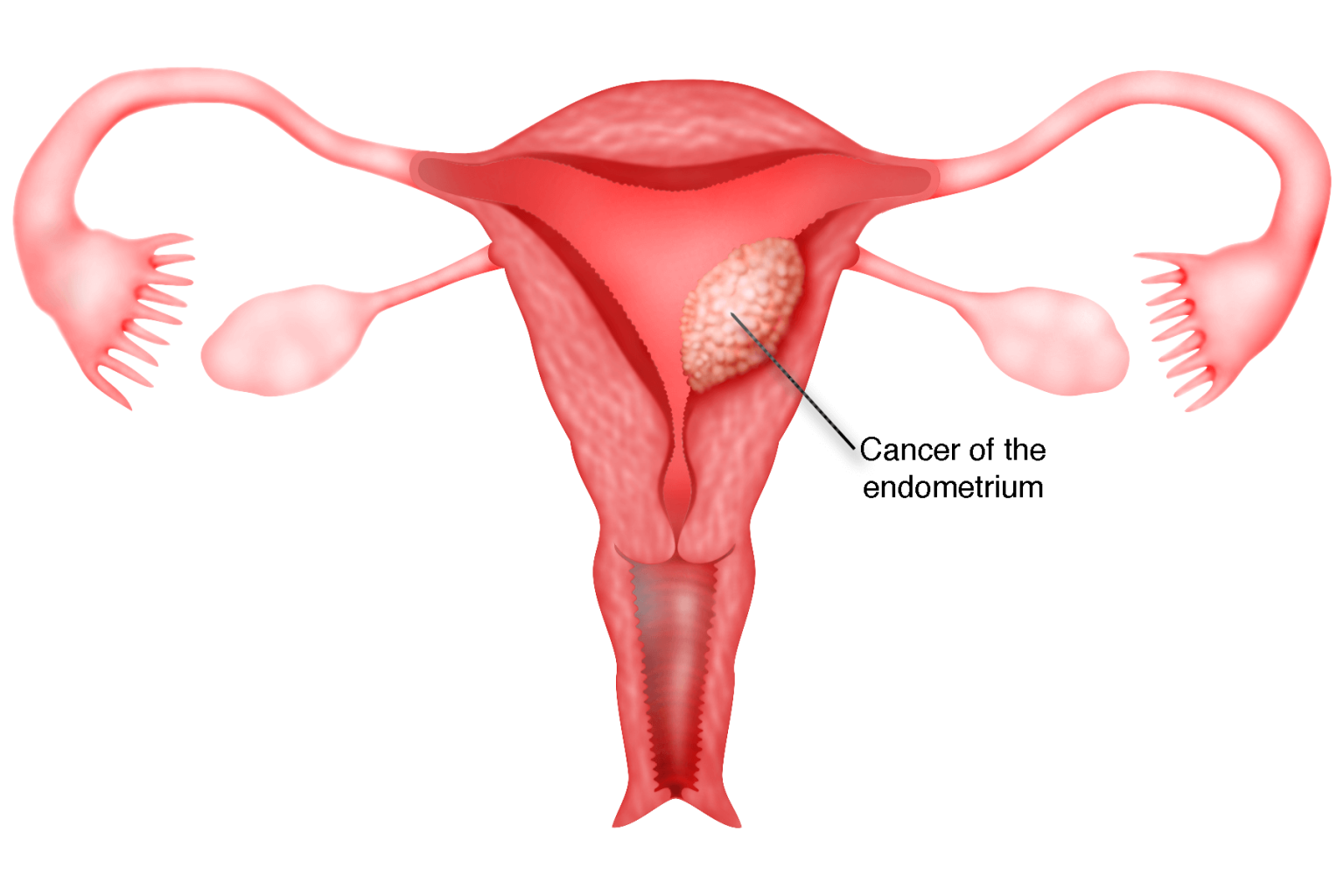 рак матки от спермы фото 81