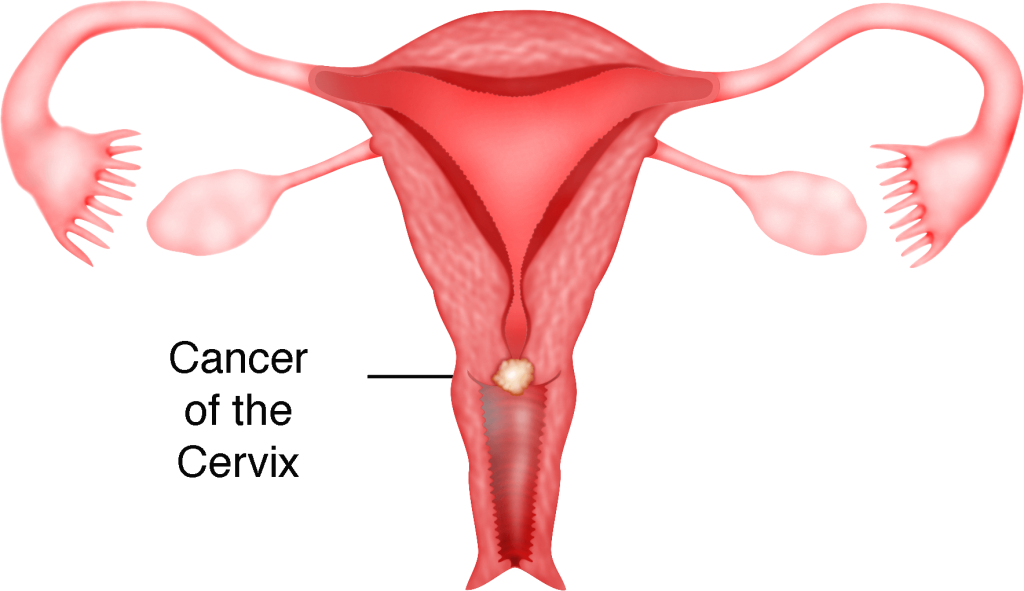Chapter 13 – Cancer of the Cervix – Melaka Fertility