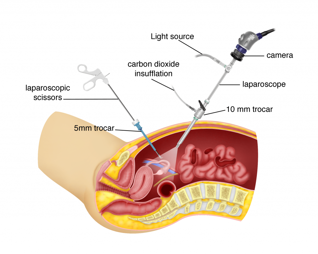 Laparoscopy