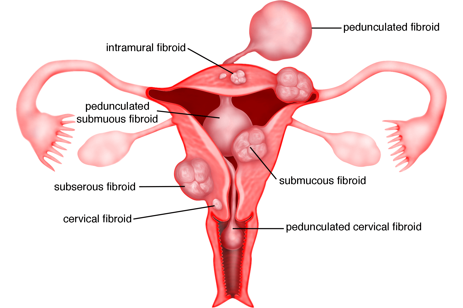 thesis topics on fibroids