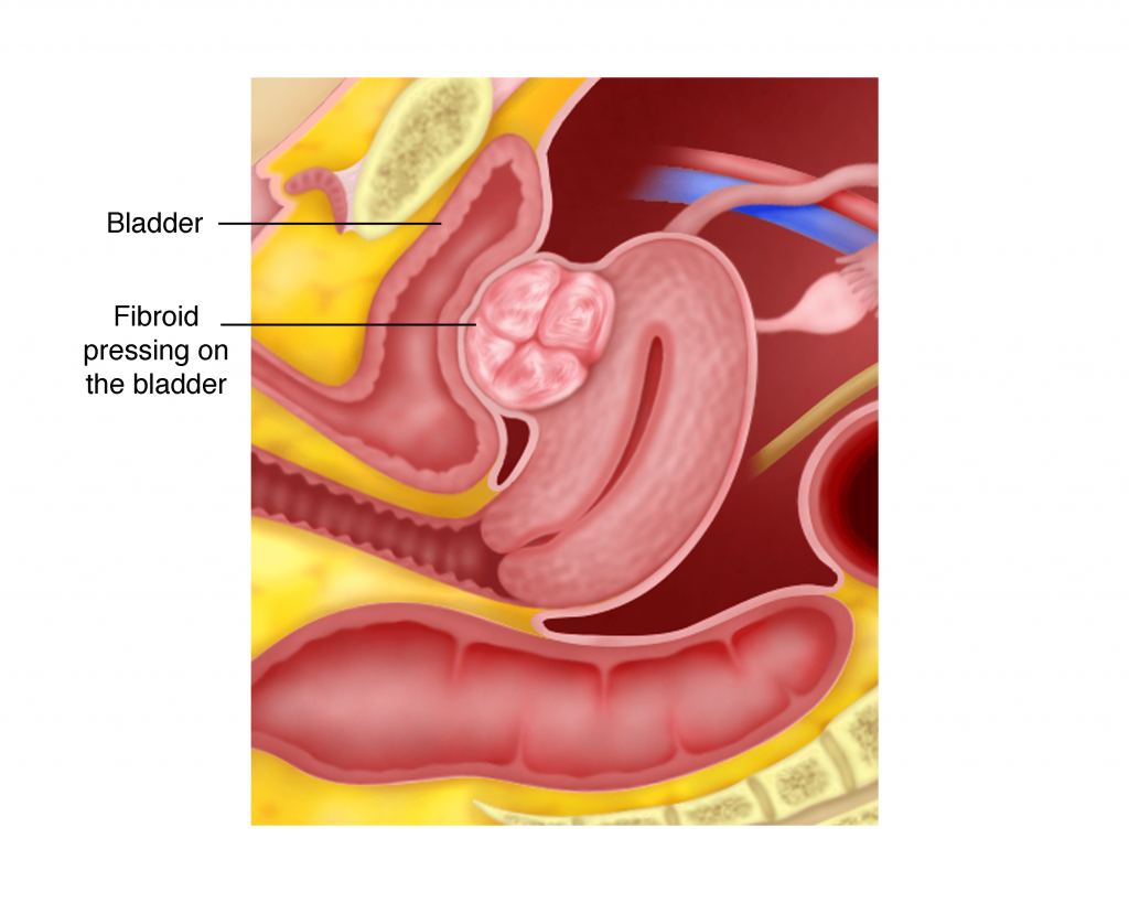 Chapter 2 – Uterine Fibroids – Melaka Fertility