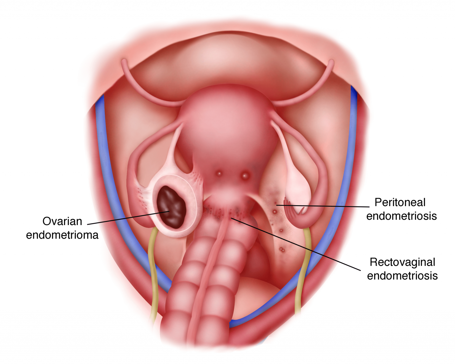Психосоматика эндометриоза матки. Экстрагенитальный эндометриоз. Экстрагенитальный эндометриоз пупка. Эндометриоз тазовой брюшины.