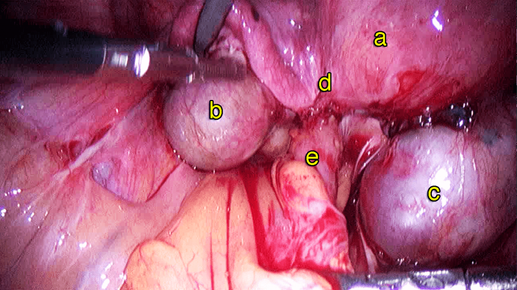 Chapter 3 – Endometriosis – Melaka Fertility