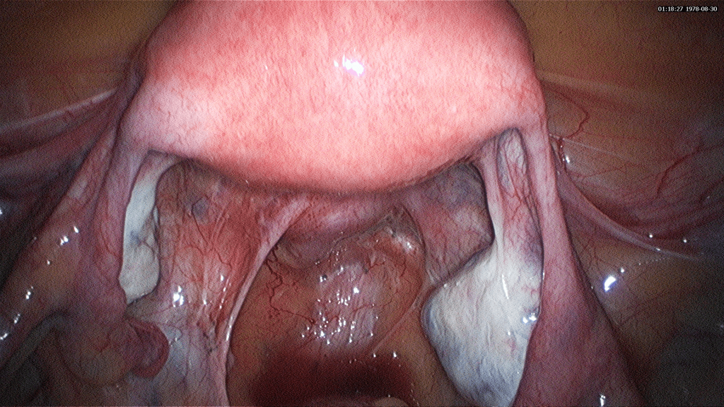 laparoscopic hysterectomy before and after