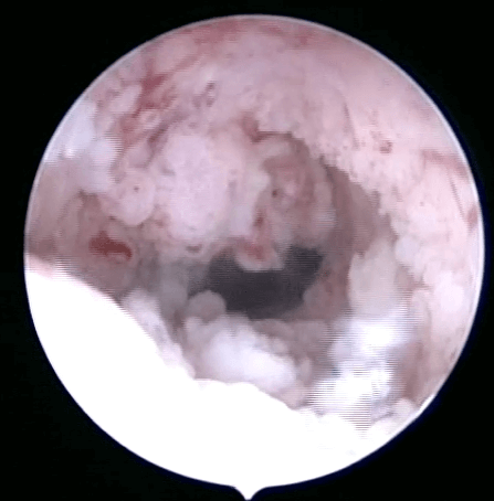 hysteroscopy abnormal uterine endometrium bleeding bab perdarahan uterus