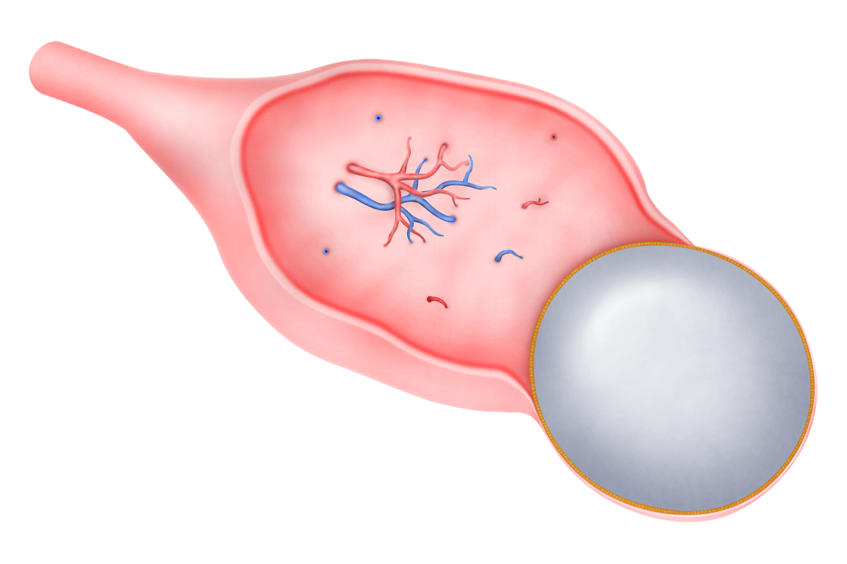 Эндометриоидная киста яичника.