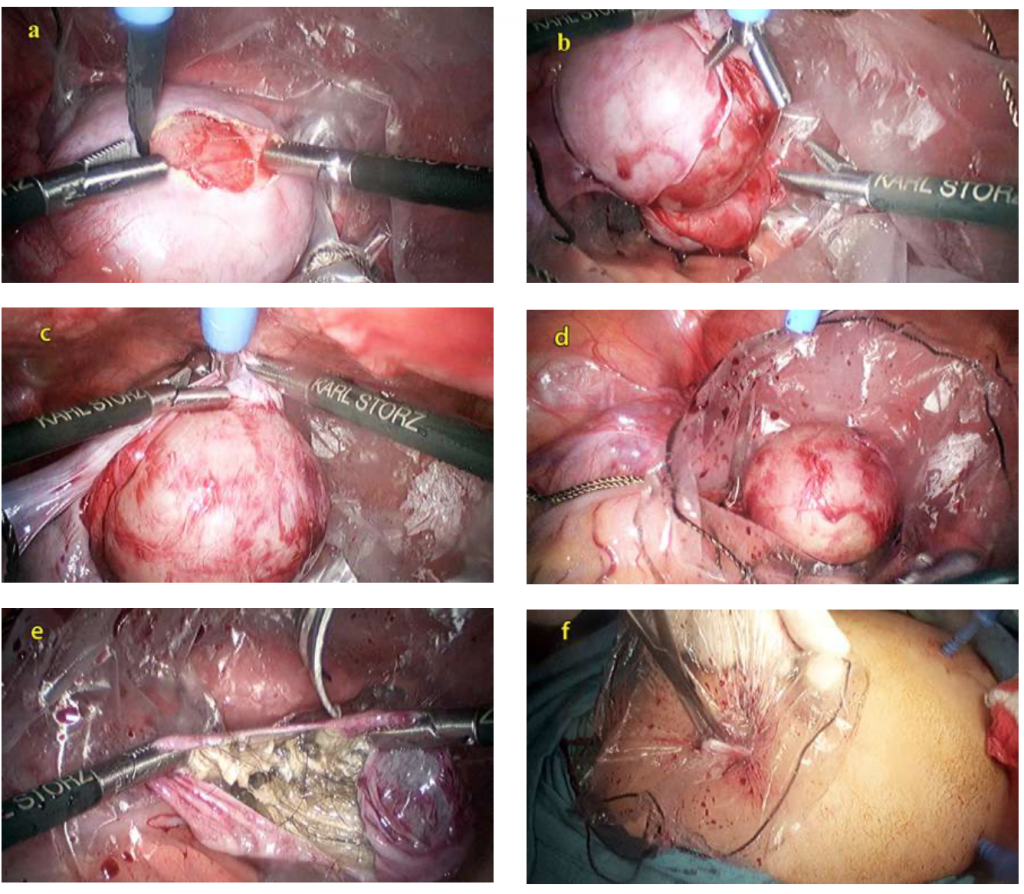 Chapter 27 – Laparoscopic Surgery for Ovarian Cyst – Melaka Fertility