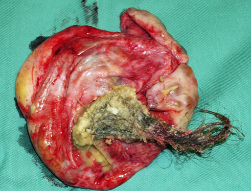 Dermoid cyst - Melaka Fertility
