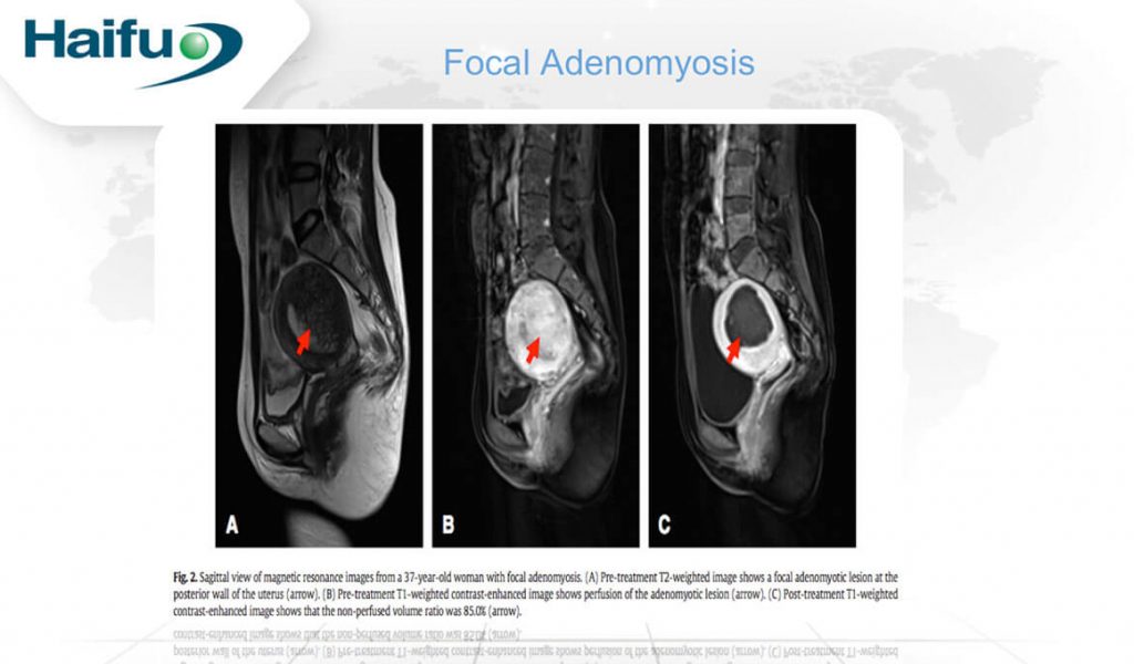 Figure 3: Focal Adenomyosis